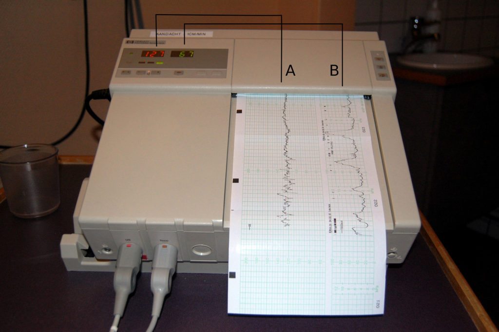 Image source: https://upload.wikimedia.org/wikipedia/commons/5/50/Cardiotocography_diagram.jpg