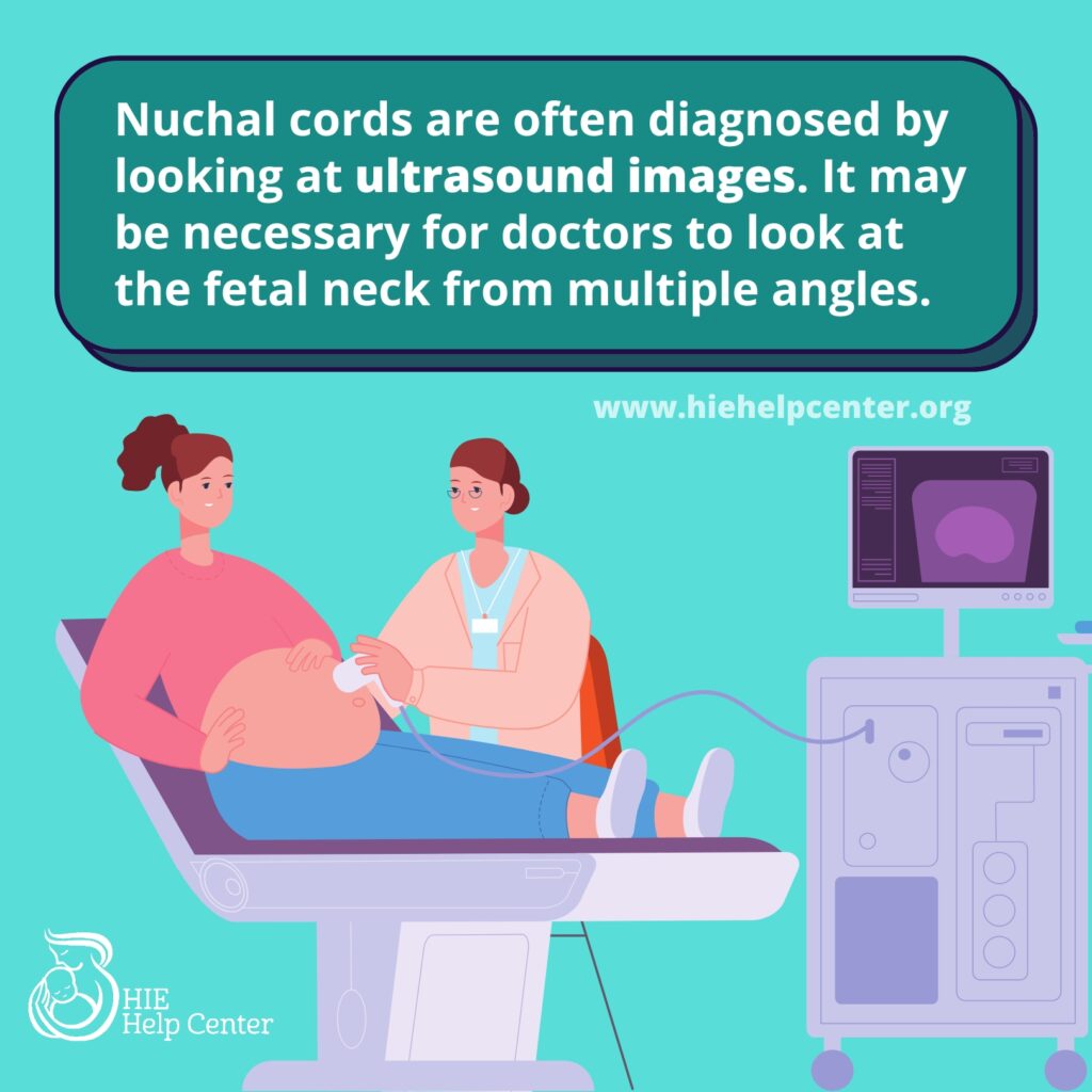 10 Things to Know About Nuchal Cords | HIE Help Center