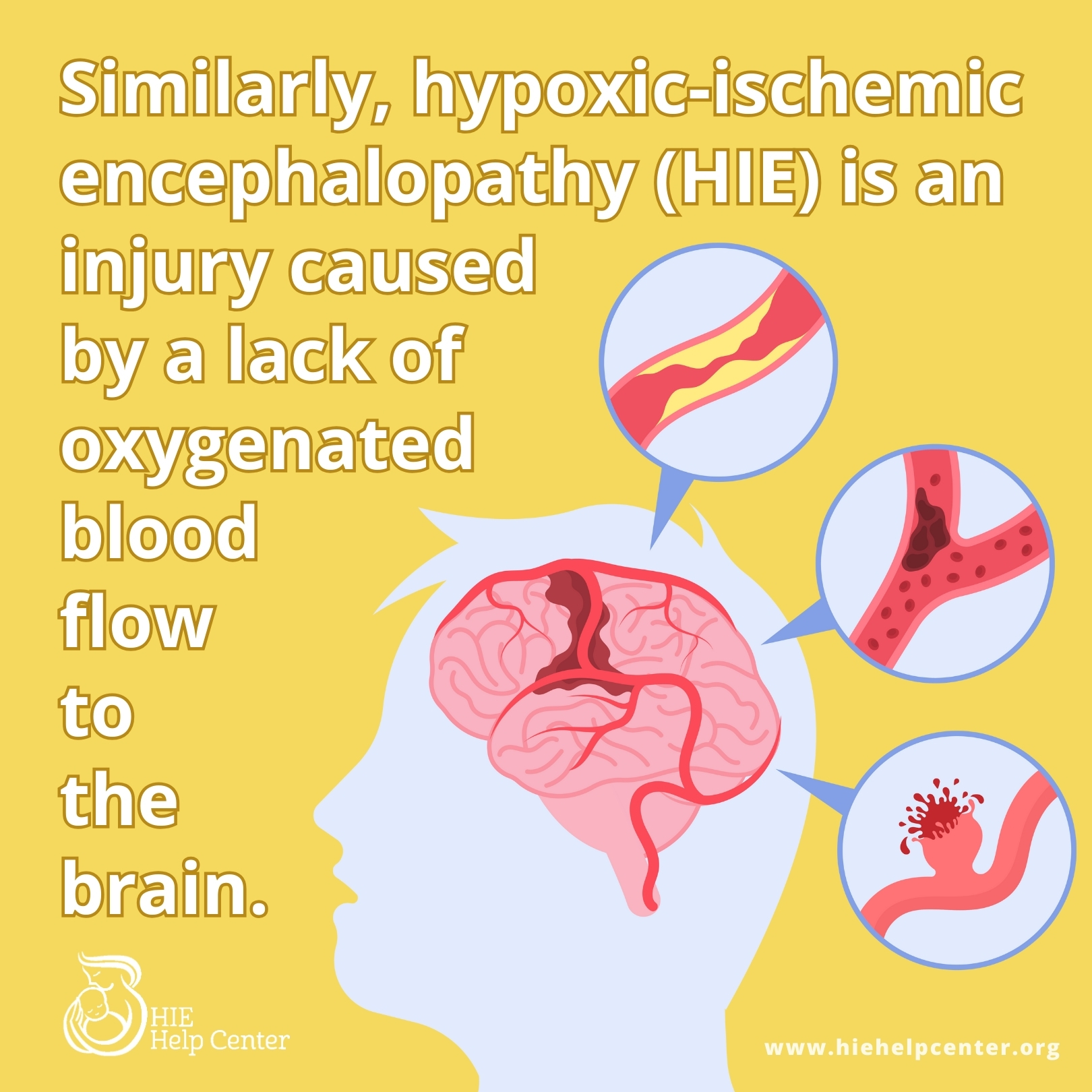 Perinatal Stroke Causes Of Hypoxic Ischemic Encephalopathy