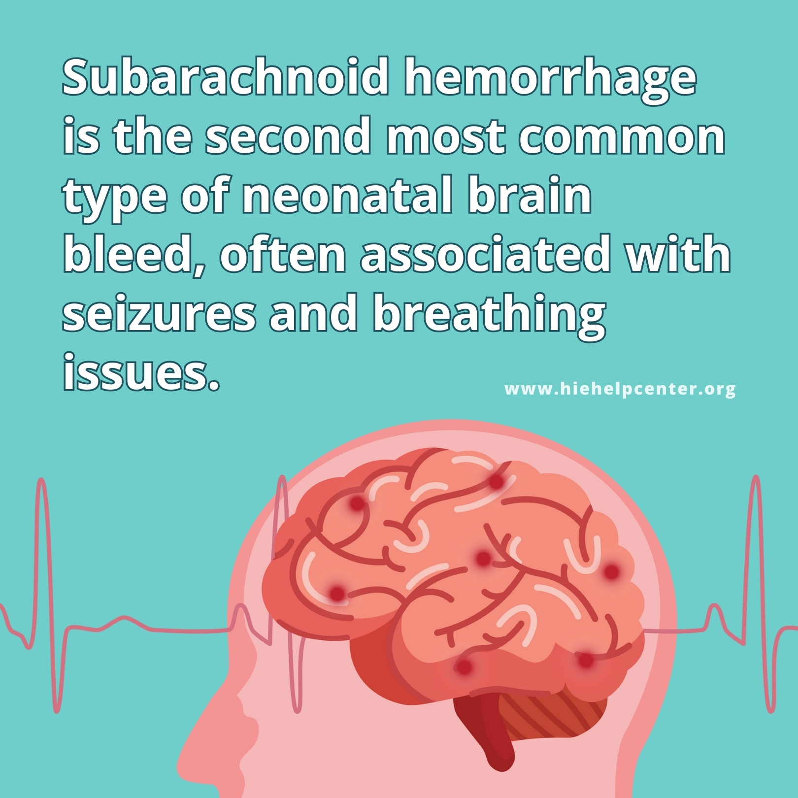 Intracranial Hemorrhages (Brain Bleeds) and Birth Injuries